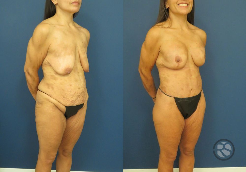 Before photo - Angle 3