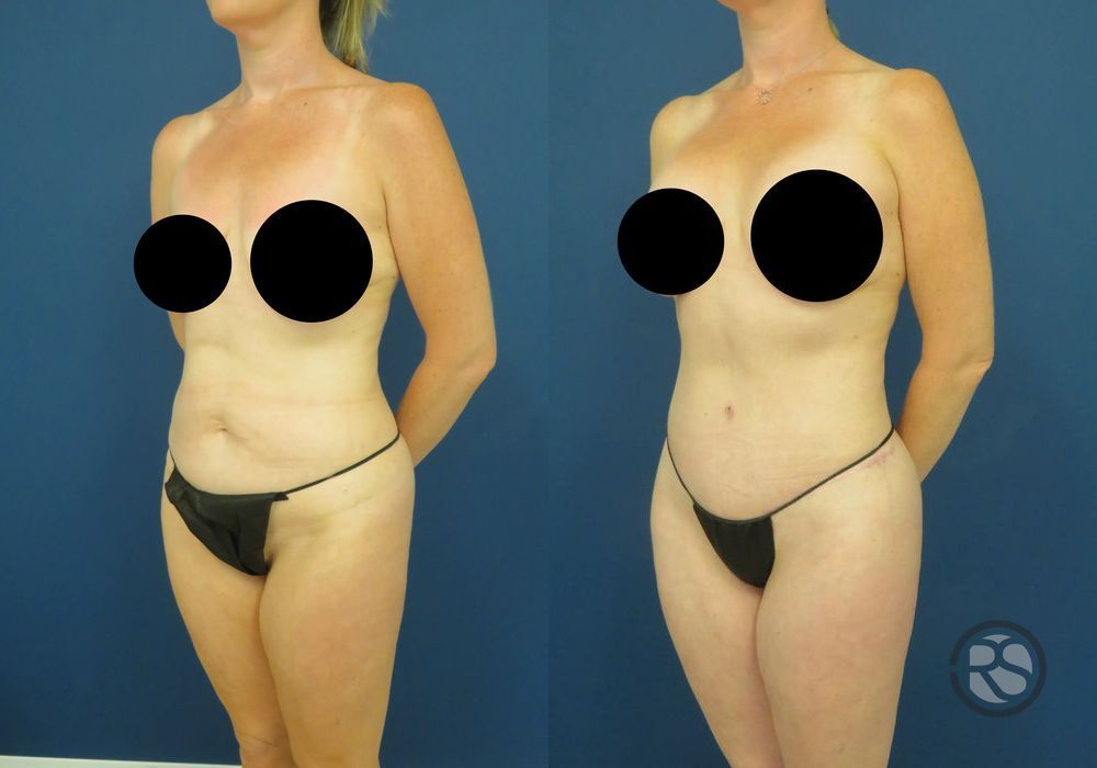 Before photo - Angle 4