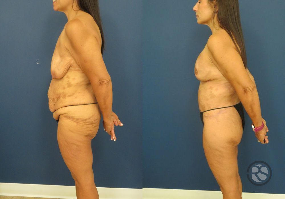 Before photo - Angle 4