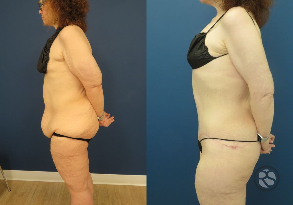 Before photo - Angle 4