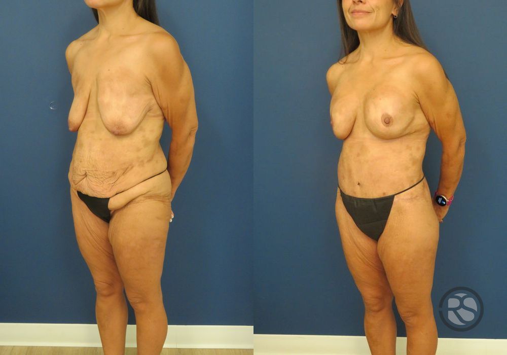 Before photo - Angle 5