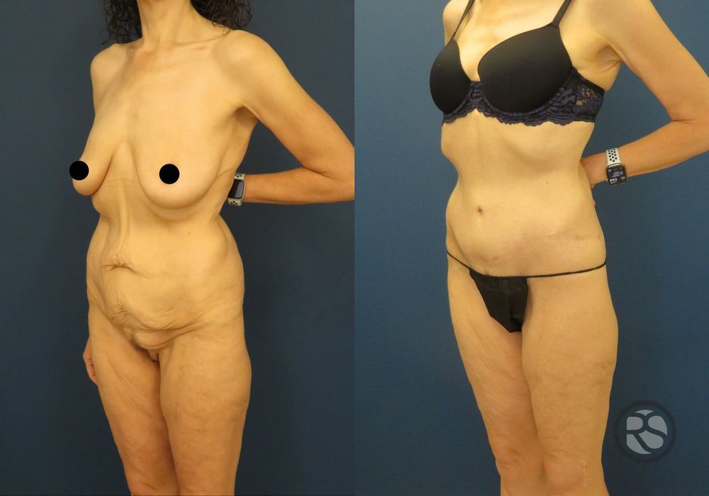 Before photo - Angle 4