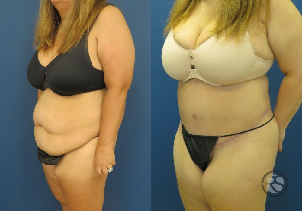 Before photo - Angle 4