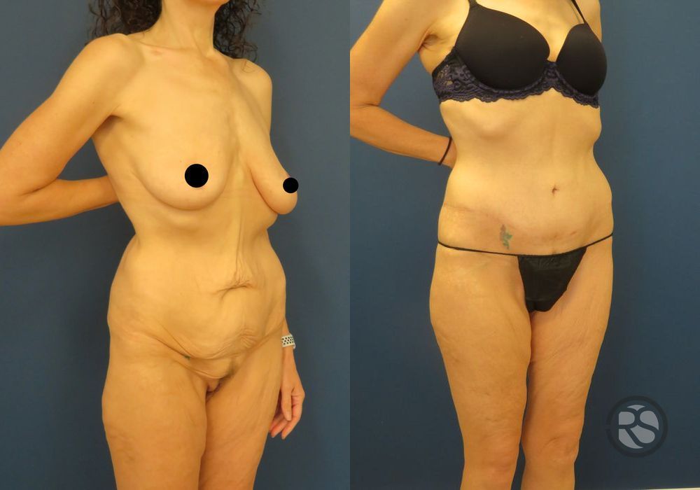 Before photo - Angle 2