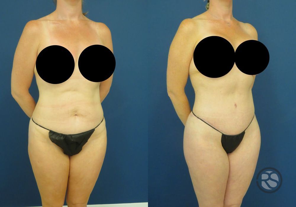 Before photo - Angle 2