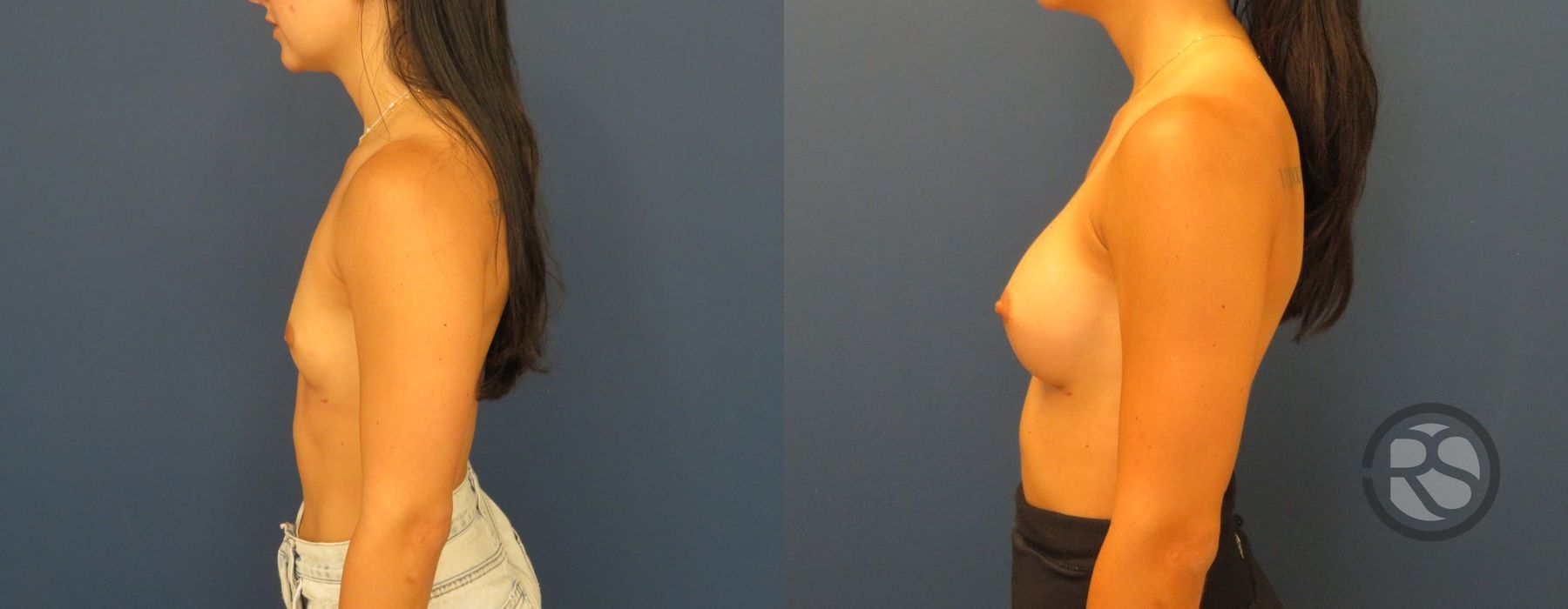 Before photo - Angle 4