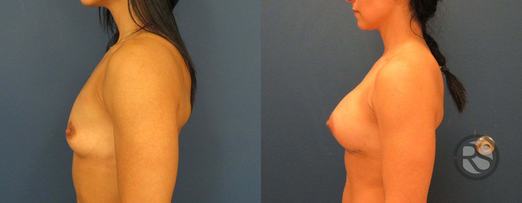 Before photo - Angle 3