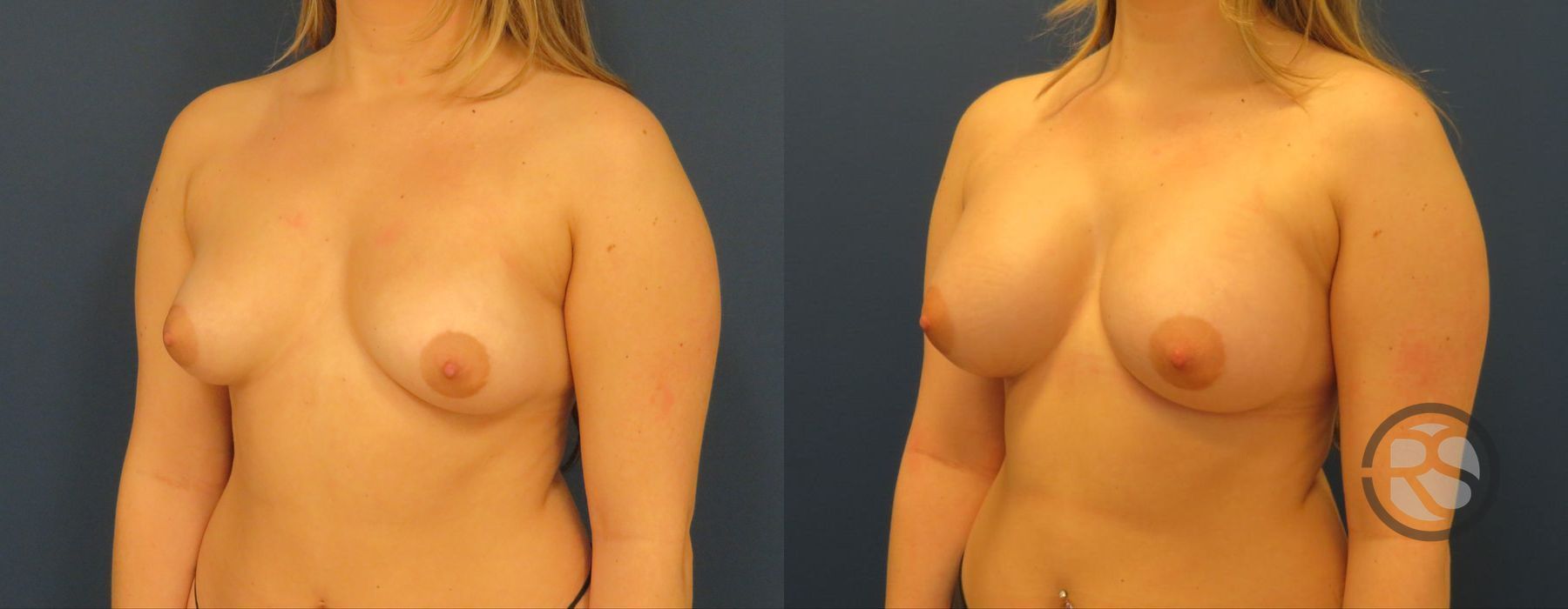 Before photo - Angle 2