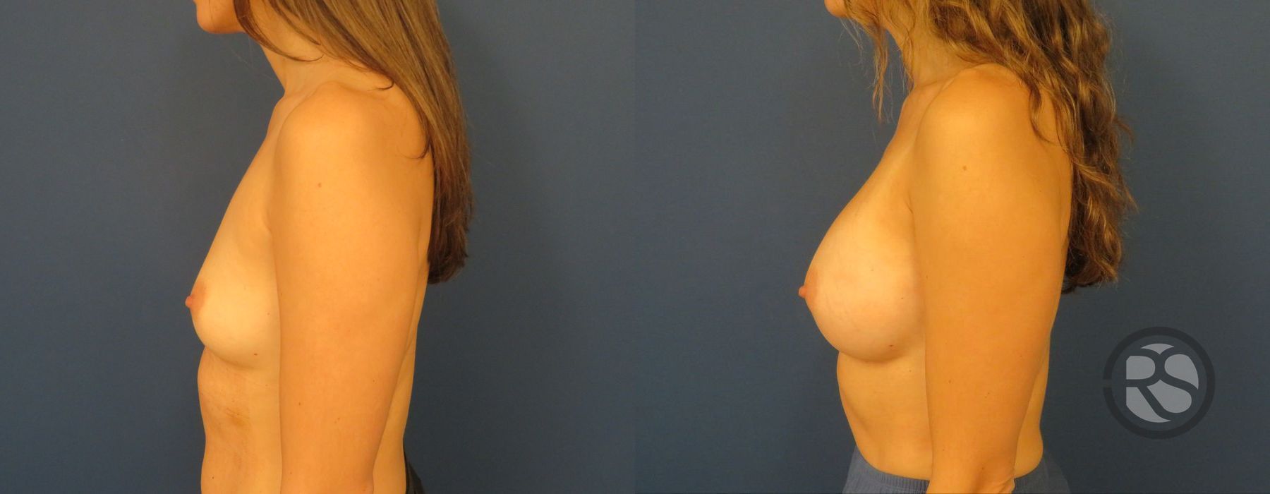 Before photo - Angle 5