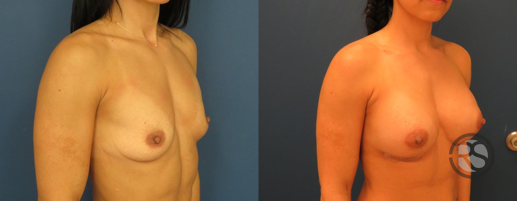 Before photo - Angle 4