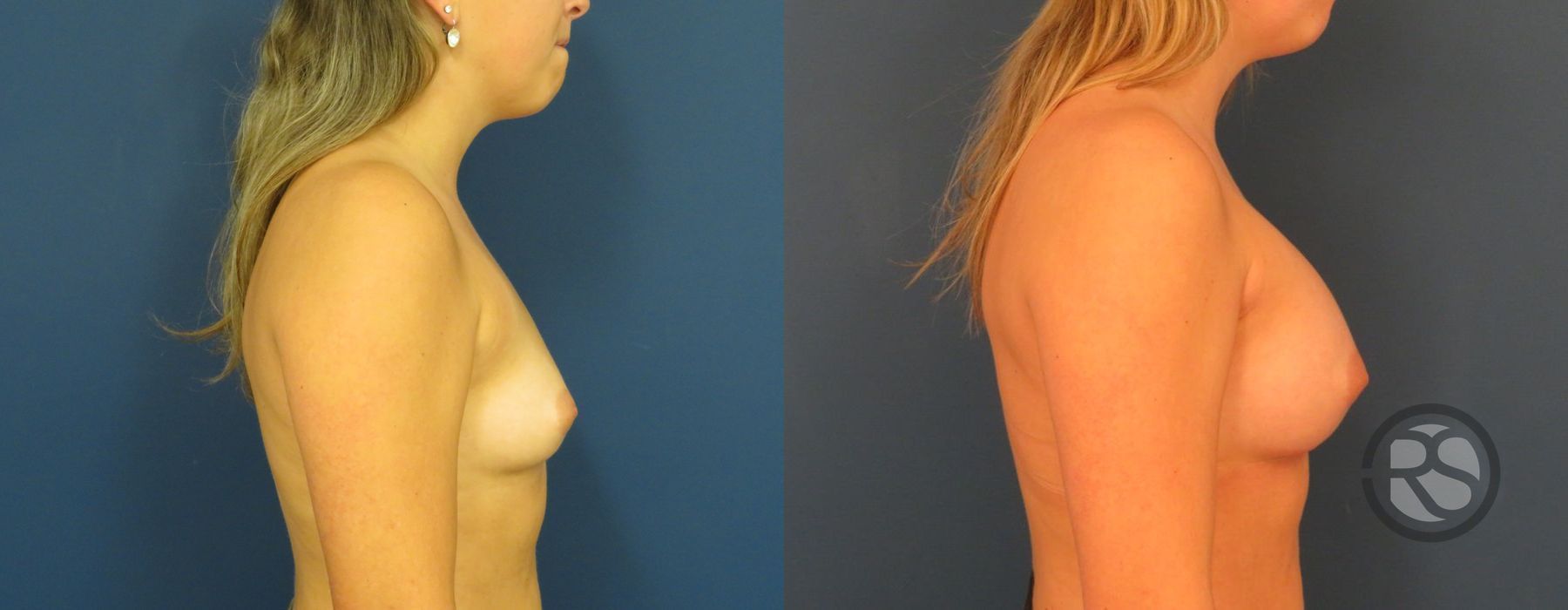 Before photo - Angle 3