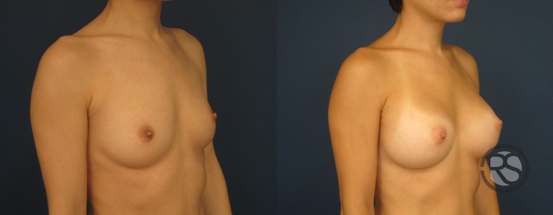 Before photo - Angle 4