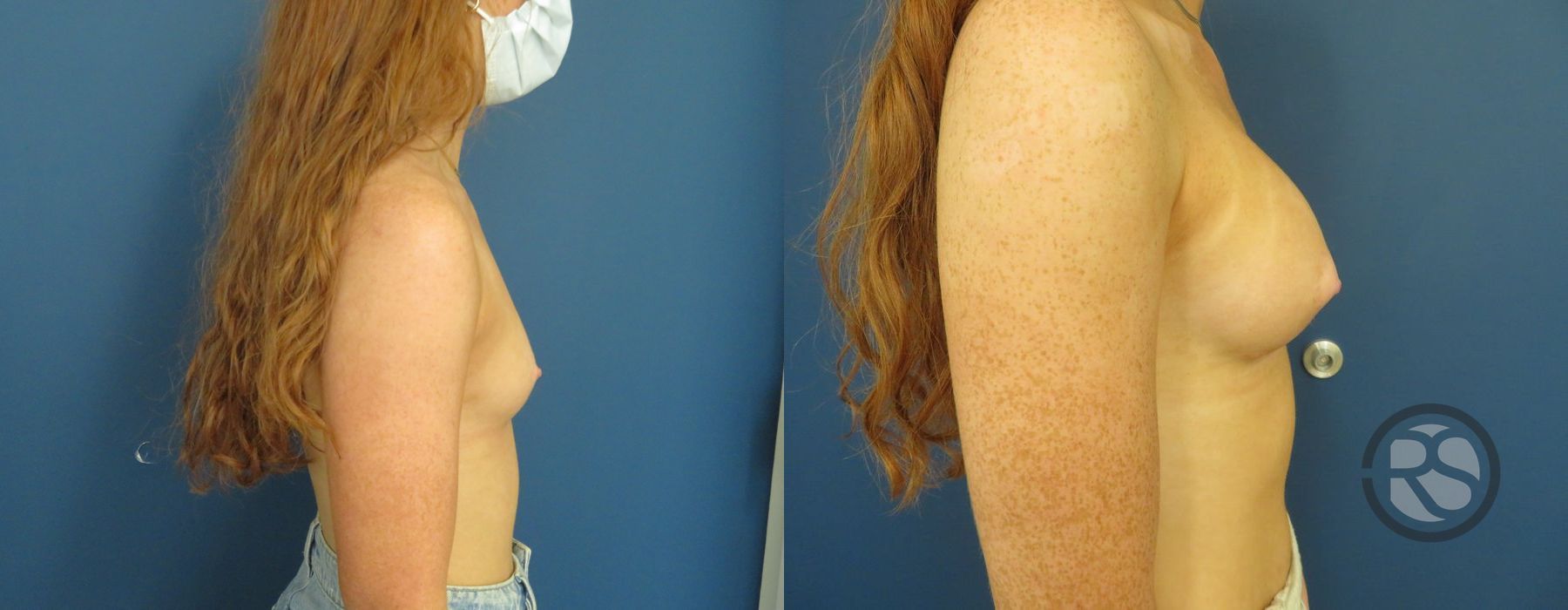 Before photo - Angle 5