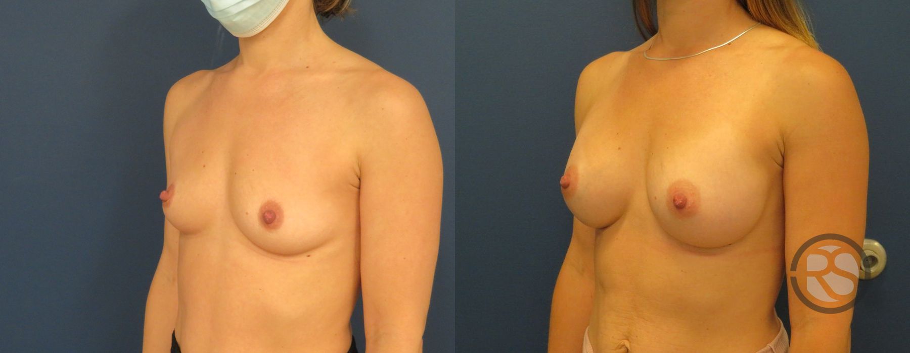 Before photo - Angle 4