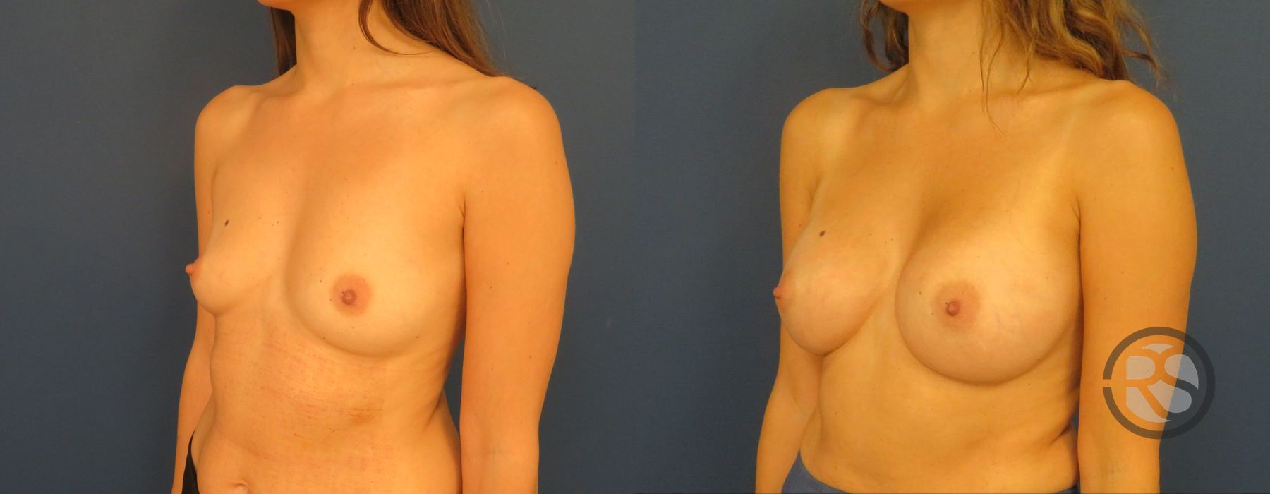 Before photo - Angle 4