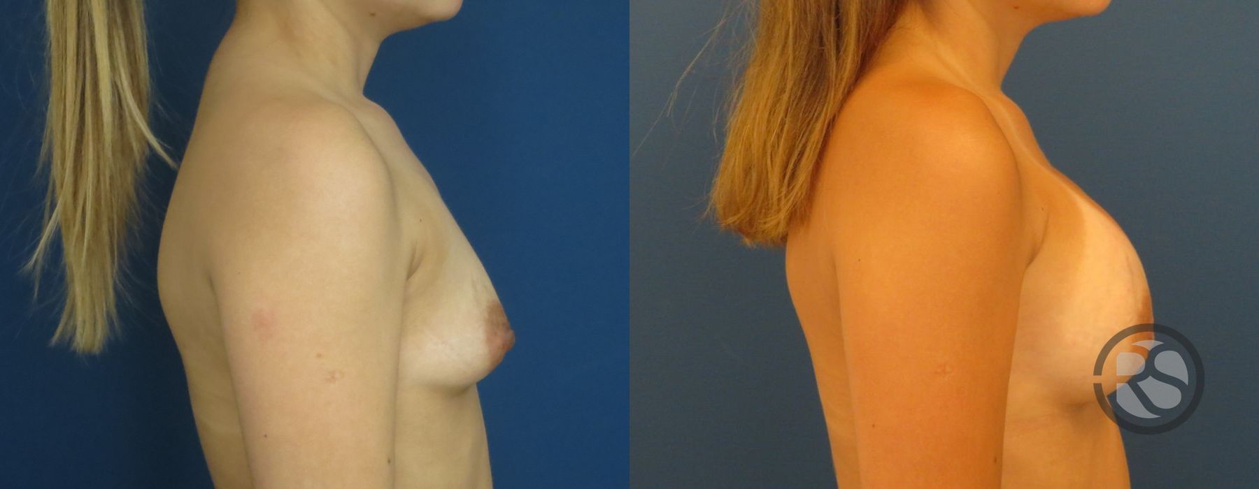 Before photo - Angle 3