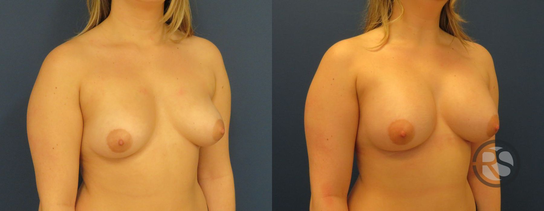 Before photo - Angle 4