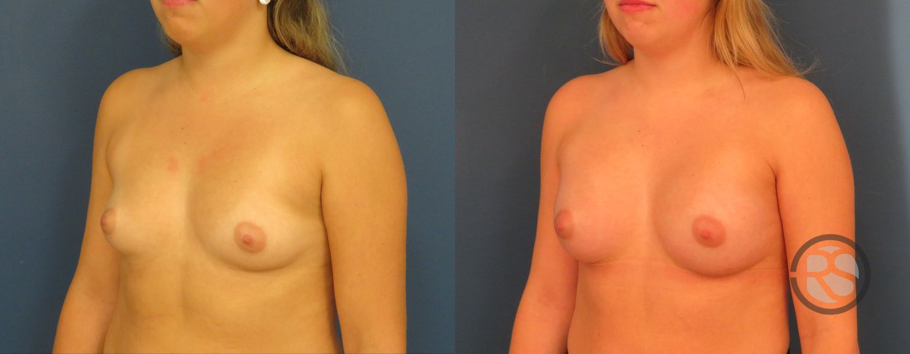 Before photo - Angle 4