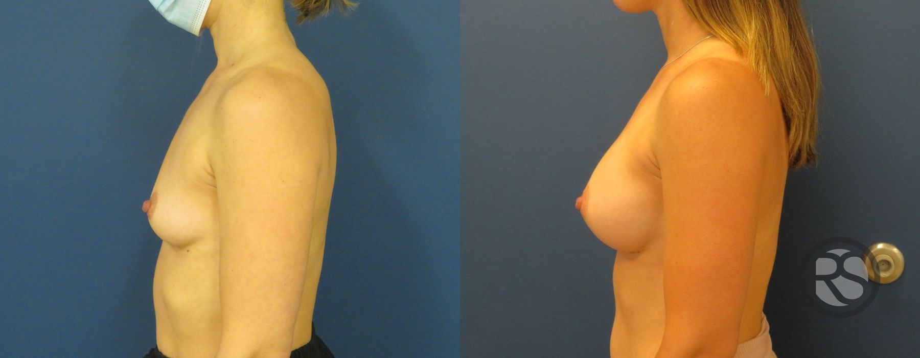 Before photo - Angle 5