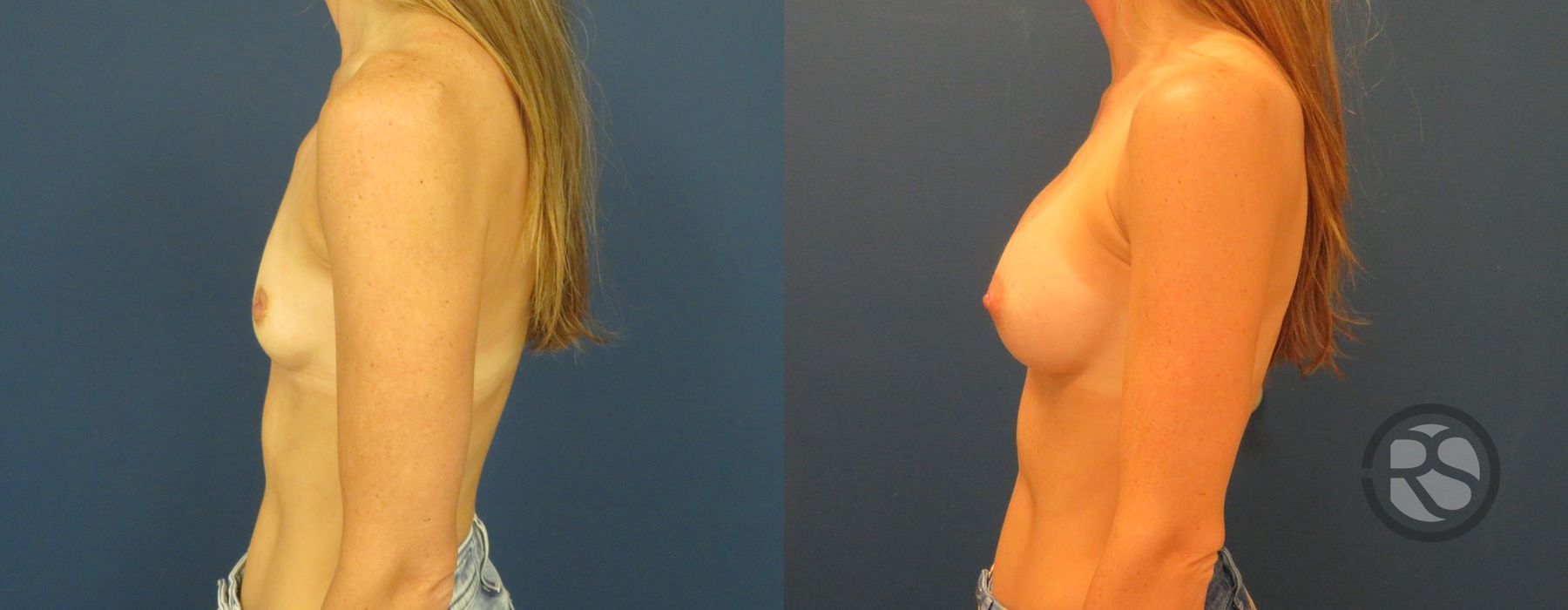 Before photo - Angle 5