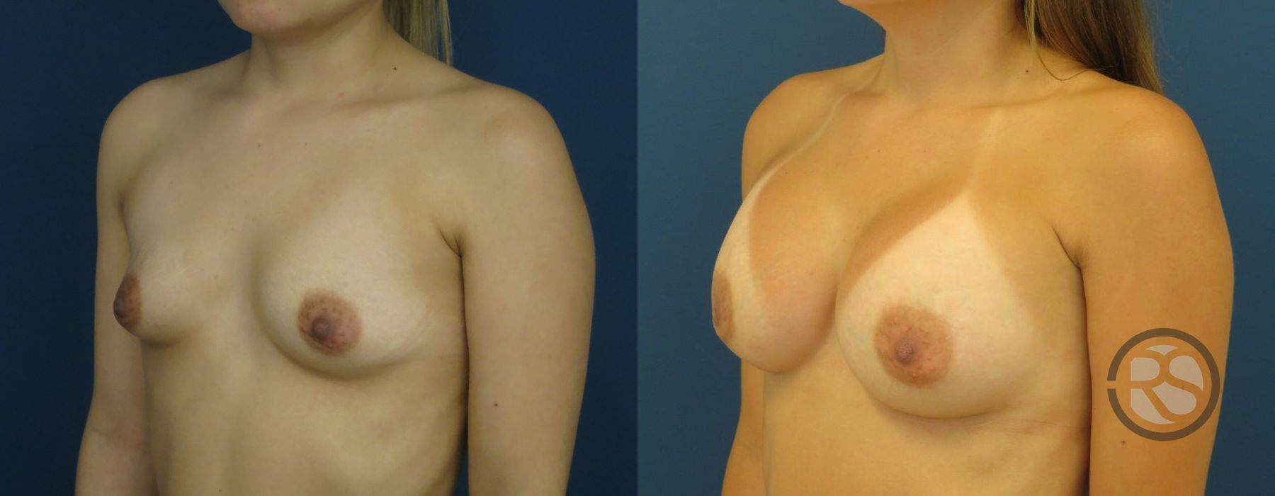 Before photo - Angle 4