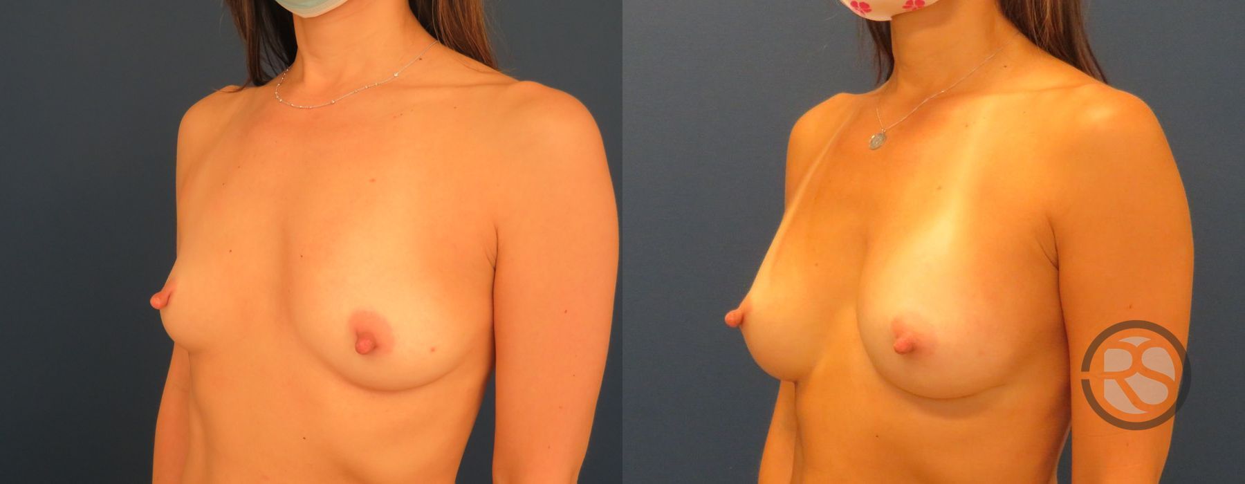 Before photo - Angle 4