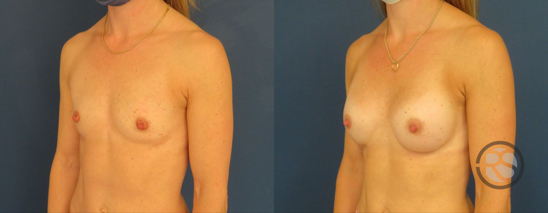 Before photo - Angle 2