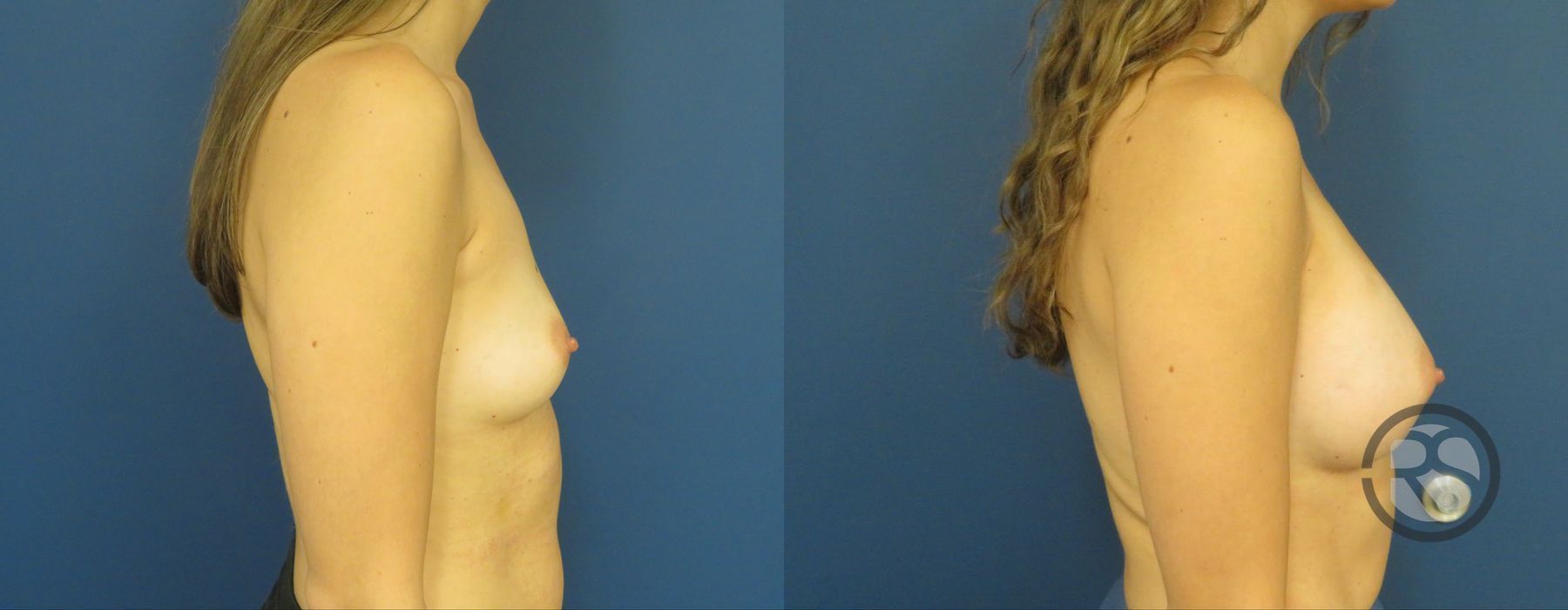 Before photo - Angle 3