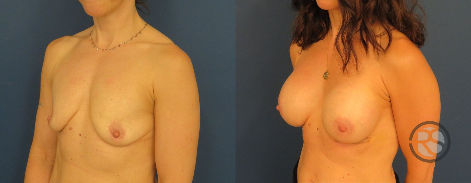 Before photo - Angle 4