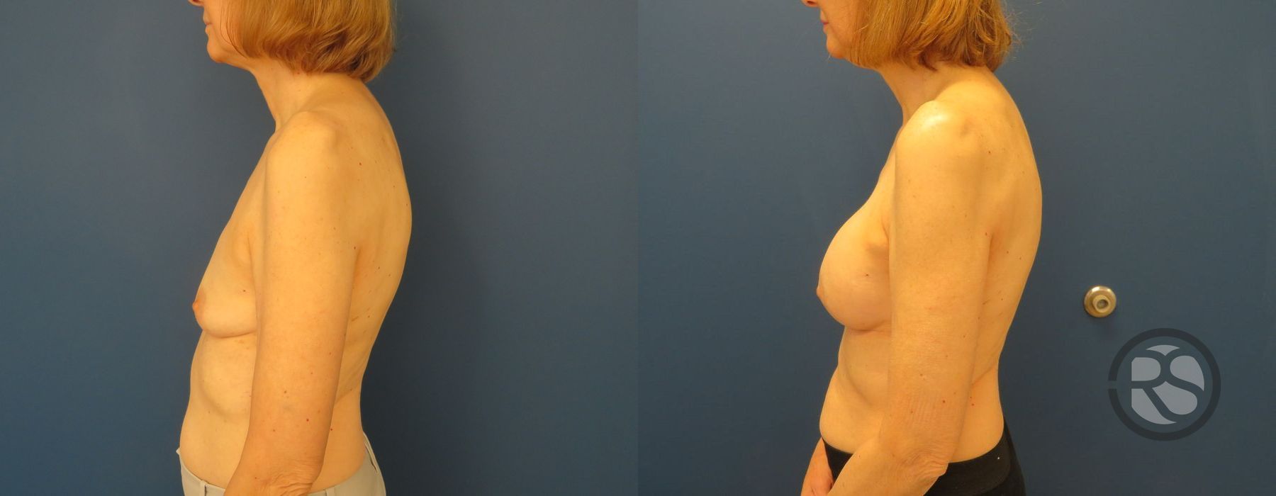 Before photo - Angle 3