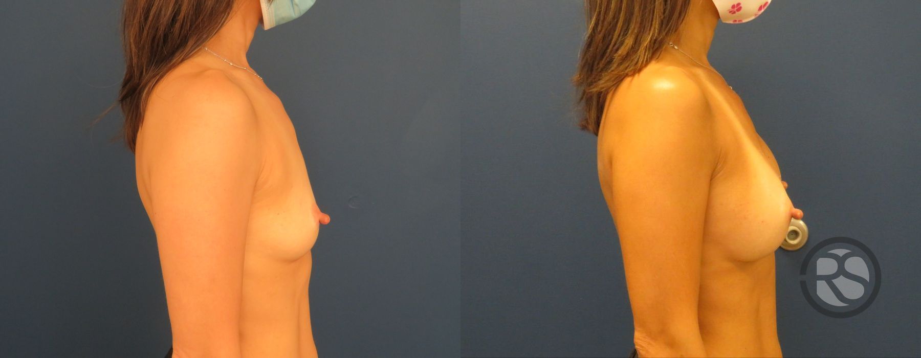 Before photo - Angle 3