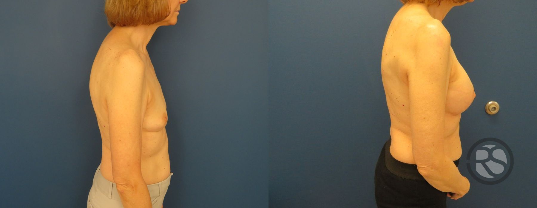 Before photo - Angle 5