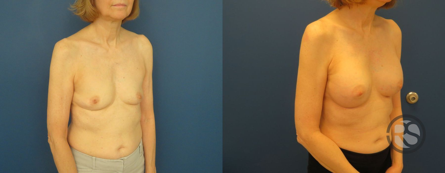 Before photo - Angle 4