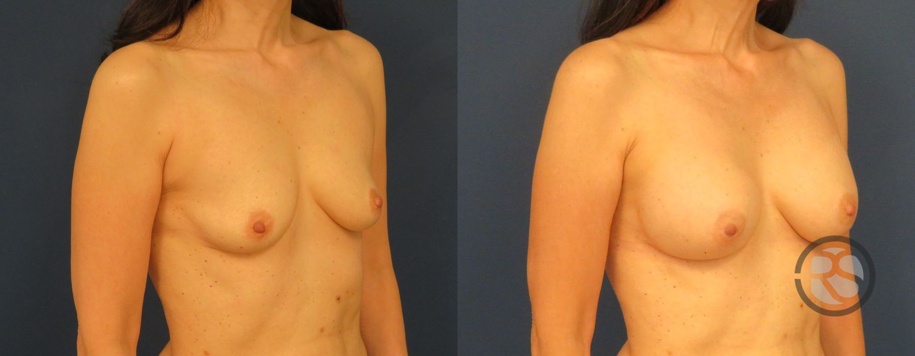 Before photo - Angle 4