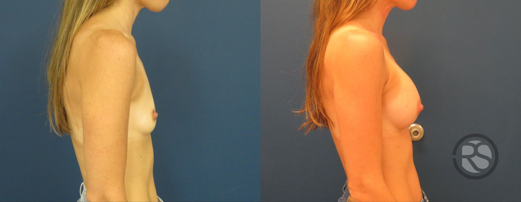 Before photo - Angle 3