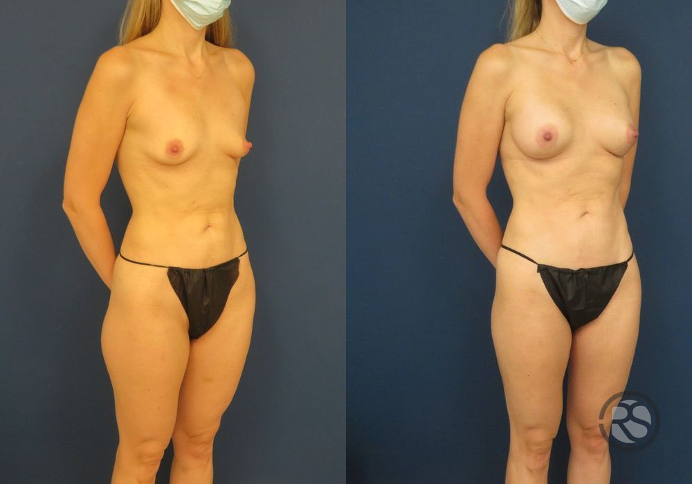 Before photo - Angle 2