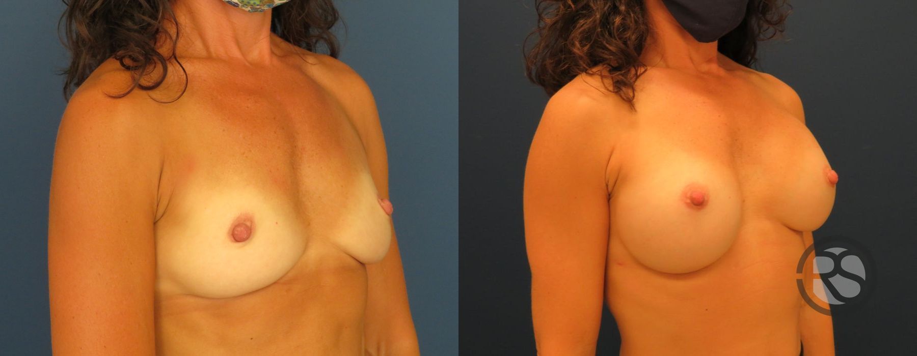 Before photo - Angle 4