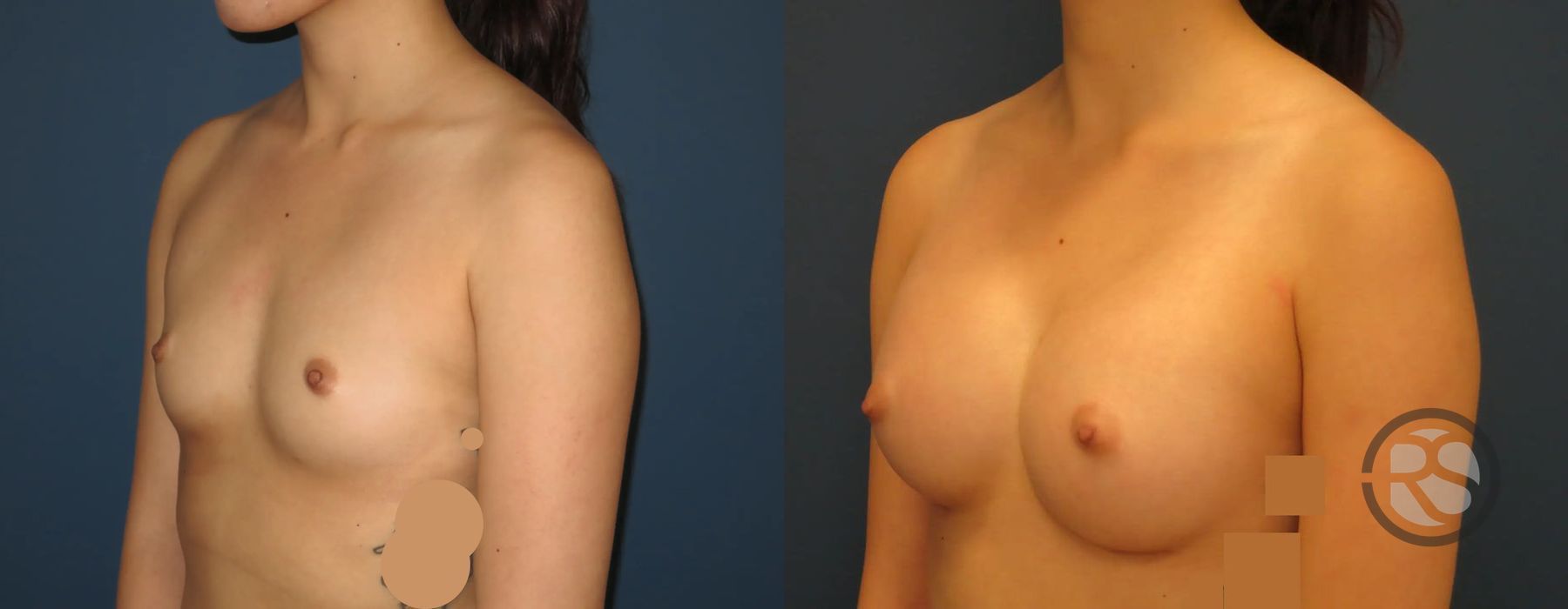 Before photo - Angle 4