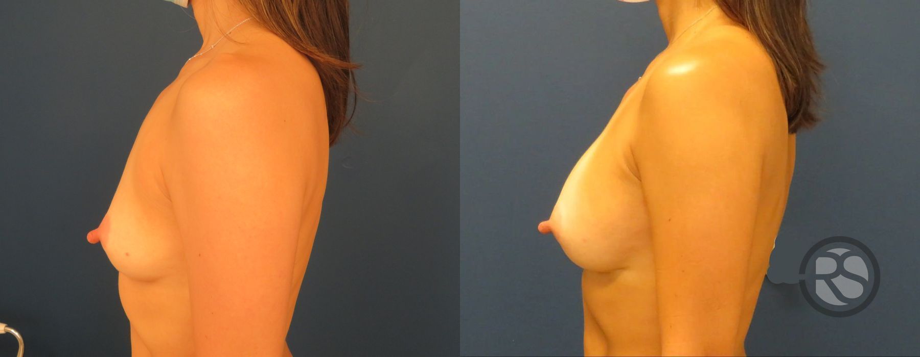 Before photo - Angle 5