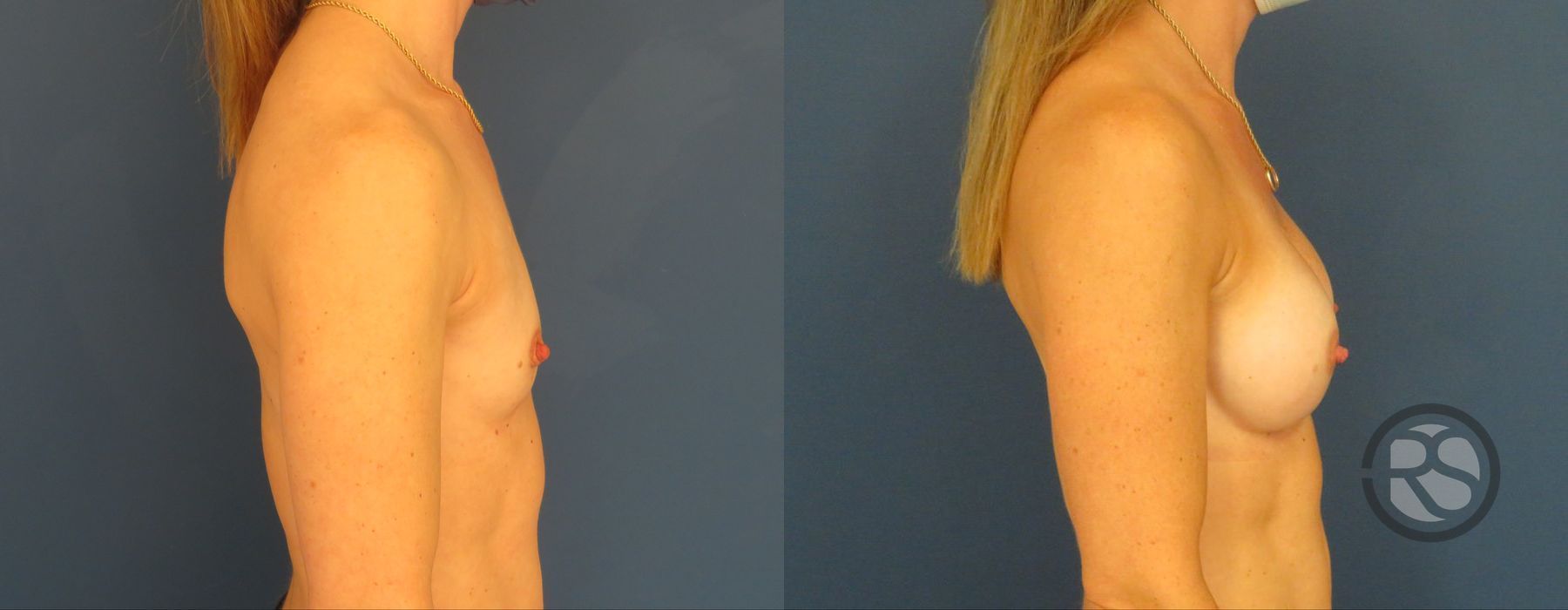 Before photo - Angle 5