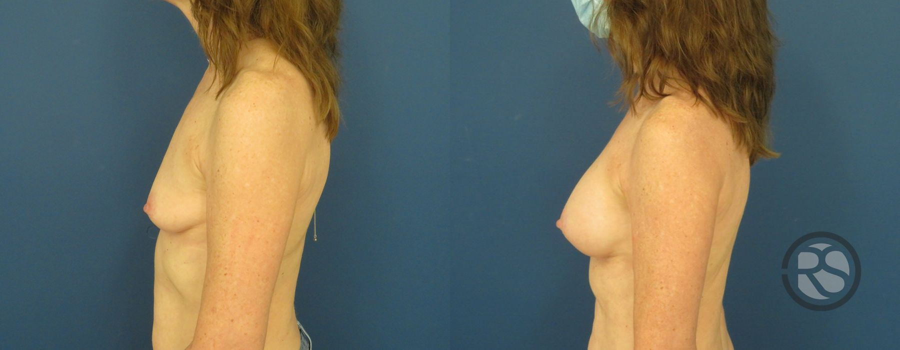 Before photo - Angle 5