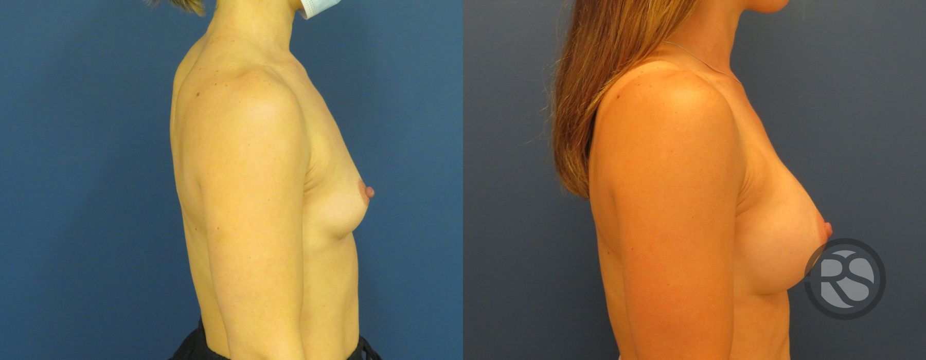 Before photo - Angle 3