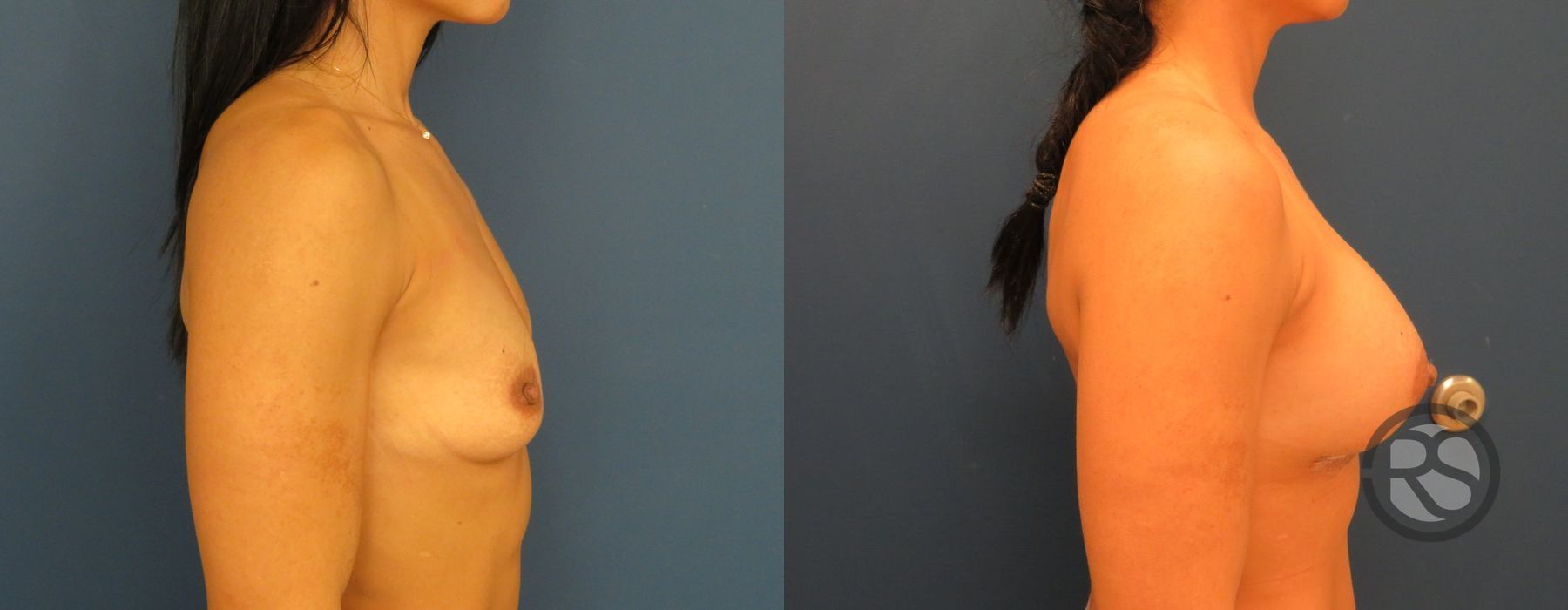 Before photo - Angle 5