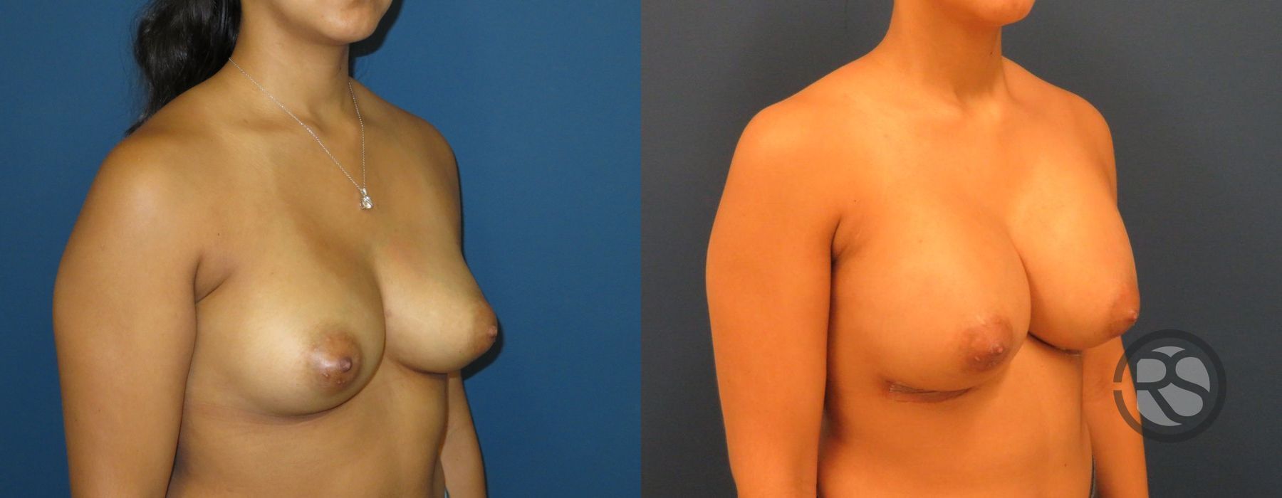 Before photo - Angle 4