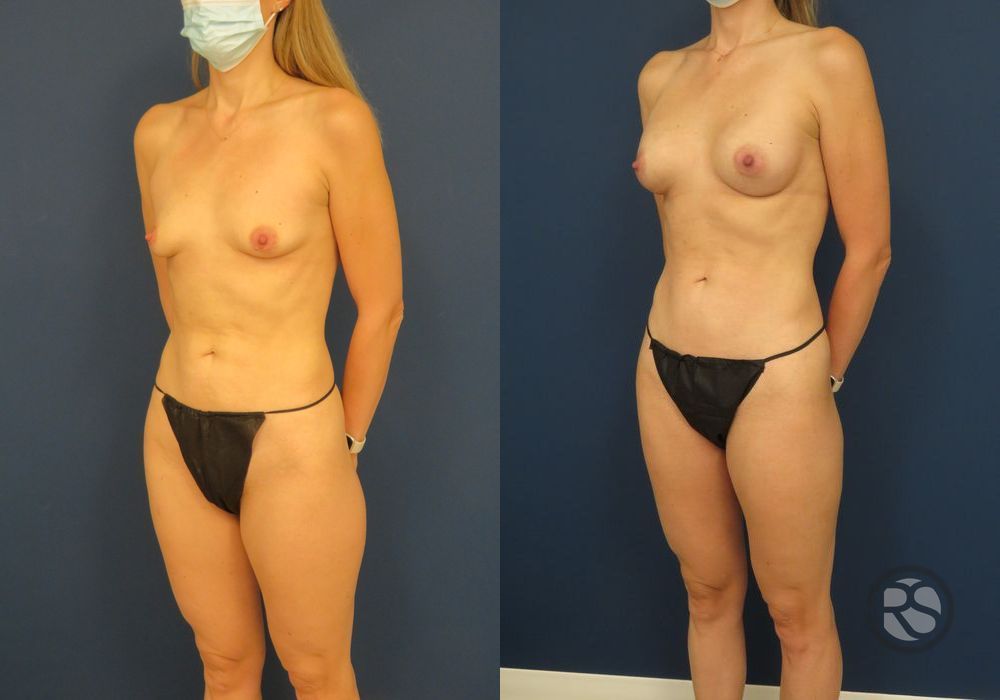 Before photo - Angle 4