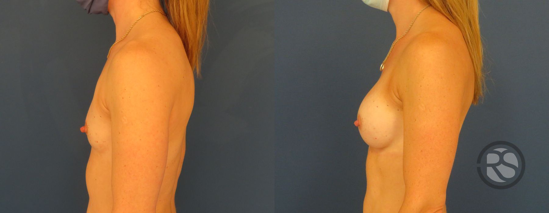 Before photo - Angle 3