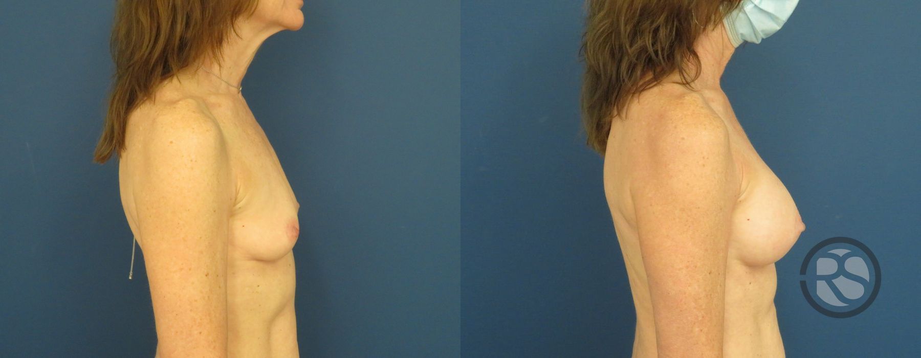 Before photo - Angle 3