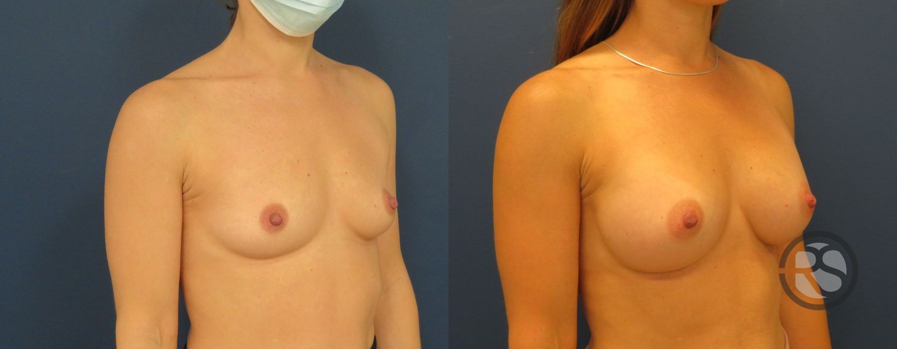 Before photo - Angle 2