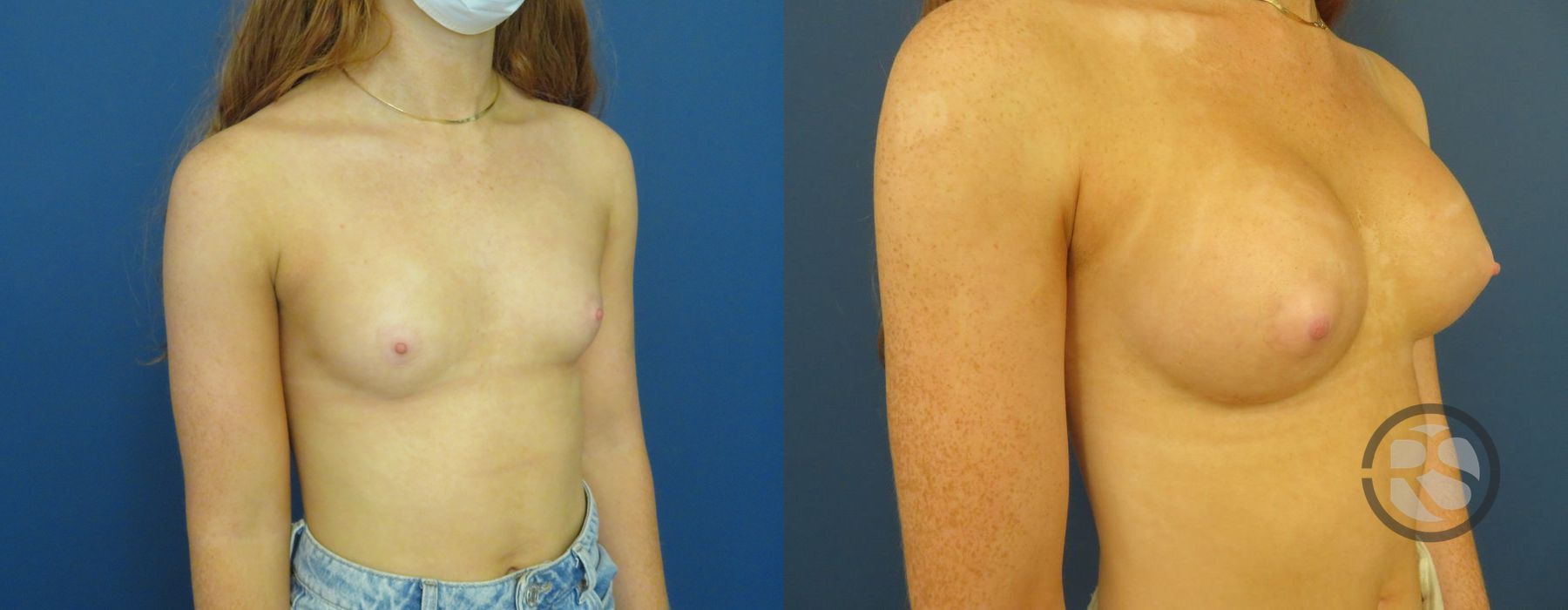 Before photo - Angle 4