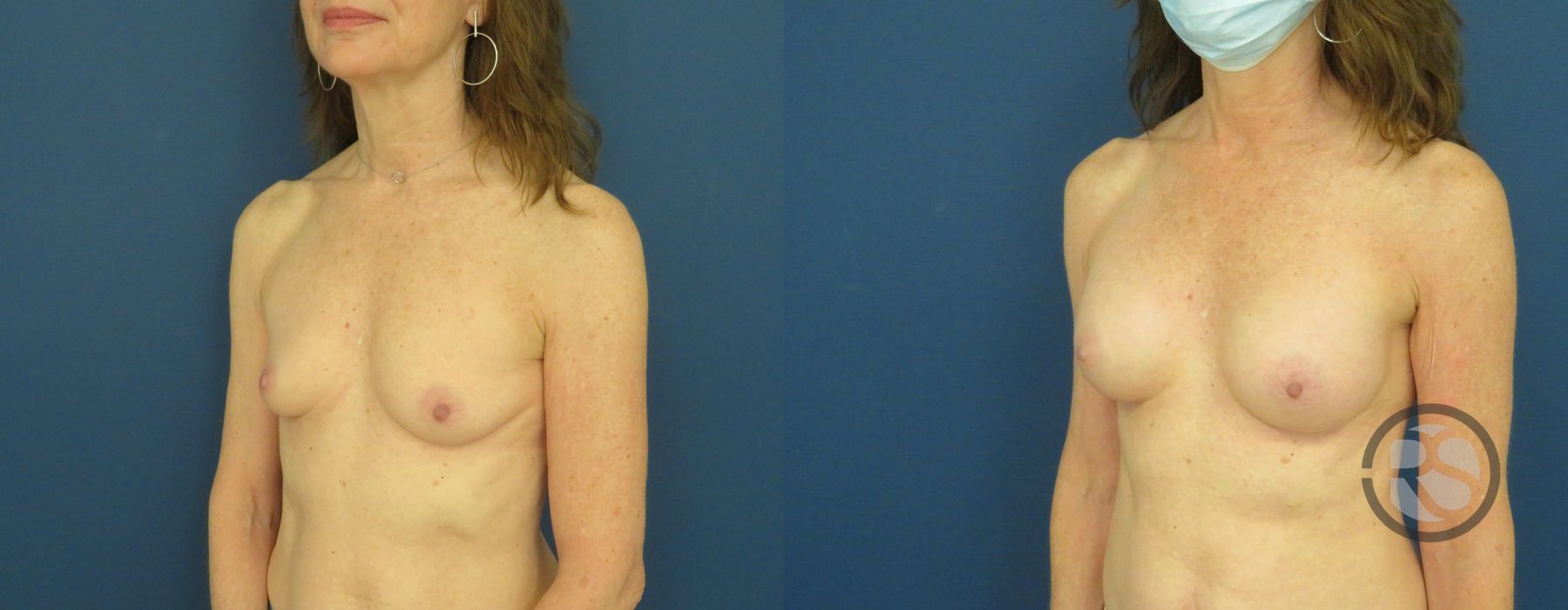 Before photo - Angle 4